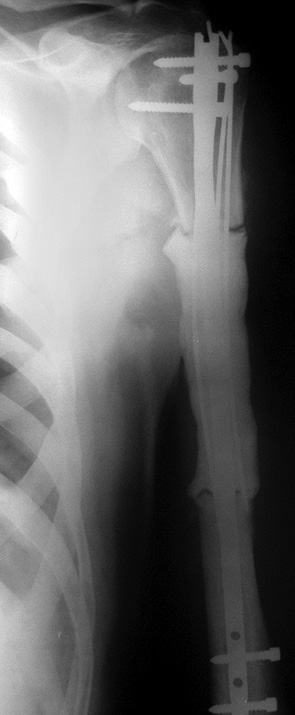 Рис. 5. Фотоотпечаток рентгенограм­мы правого плеча пациента Х. (50 лет) после операции
