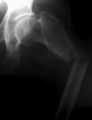 Рис. 7. Фотоотпечаток рентгенограммы левого бедра пациента С. (52 года) до операции
