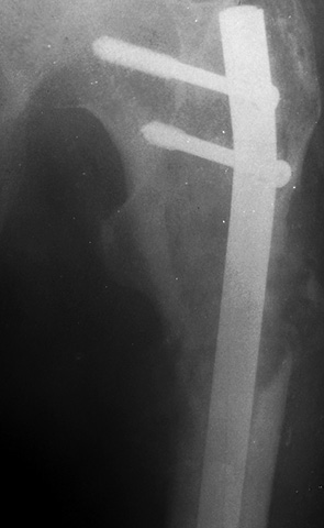 Рис. 8. Фотоотпечаток рентгенограммы левого бедра пациента С. (52 года) после операции