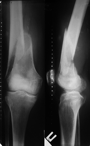 Рис. 9. Фотоотпечатки рентгенограммы правого бедра пациента О. (59 лет) до операции