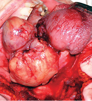 Рис. 3. Знімок ротової порожнини, який демонструє пухлину в задній ділянці кореня язика
