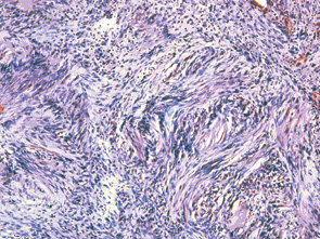 Рис. 5. Шваннома кореня язика хворої Р. Пухлина складається з веретеноподібних клітин з елонгованими ядрами. Пухлинні клітини розташовані пучками або формують «завихрення». Мікрофотографія. Заб. гематоксиліном та еозином, об. 10, ок.10