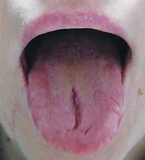 Рис. 7. Фотографія хворої Р. через 7 міс після хірургічного видалення шванноми кореня язика