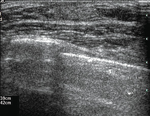 Рис. 12. Эхограмма пациентки М., 9 лет. В позадисосковой области левой ГЖ лоцируется гиперэхогенный участок без четких контуров — жировая ткань