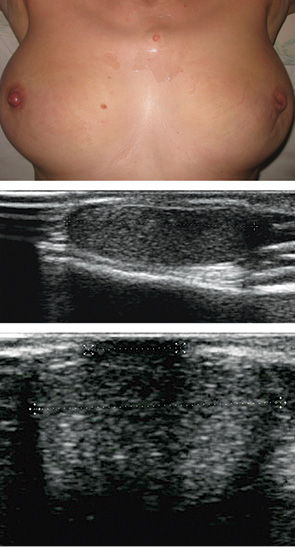 Рис. 13. Полимастия у пациентки Ж., 16 лет. На эхограммах представлено изображение дополнительной ГЖ, расположенной над проекцией грудины в виде овального участка жировой ткани, четко ограниченного, с соском над поверхностью 