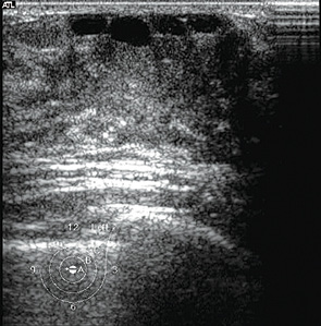 Рис. 2. Эхограммы с ЭДК пациентки Ж., 14 лет. Эктазия протоков ГЖ. (В субареолярной зоне на фоне жировой ткани лоцируется 4 анэхогенных, похожих на мелкие кисты, расположенных поверхностно в виде цепочки структуры — эктазированные протоки левой ГЖ)