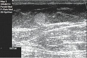Рис. 5. Эхограмма пациентки С., 15 лет. Фибролипома ГЖ. (В верхненаружном квадранте левой ГЖ лоцируется округлое, с четкими ровными контурами, гиперэхогенное, гомогенное образование диаметром 0,7 см) 