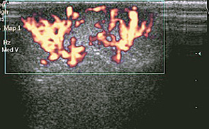 Рис. 6. Эхограмма с ЭДК пациентки Р., 14 лет. Гемангиома ГЖ. (В верхненаружном квадранте правой ГЖ лоцируется гиперэхогенный, гомогенный, с нечеткими контурами, овальный участок, захватывает нижние слои кожи, сосуды прослеживаются в виде веерообразно разветвленных сигналов).