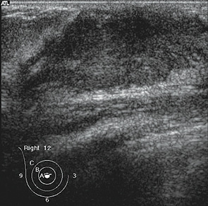 Рис. 9. Эхограмма ГЖ у пациентки С., 12 лет. Mastitis adolescentium. (Наличие клинических жалоб и отсутствие УЗ симптомов. Все поле зрения занимает железистая ткань развивающейся ГЖ)