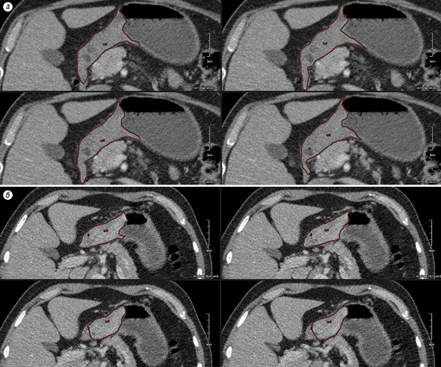 Рис. 1. Серія СКТ-знімків хворого М., 57 років, до проведення лікування (а) та після закінчення НПХТ (через 21 добу після другого курсу, б). Позначено червоним кольором площу пухлини шлунка на зрізах СКТ з інтервалом 1 мм. Обчислення показали, що в результаті проведення НПХТ об’єм пухлини зменшився на 32%