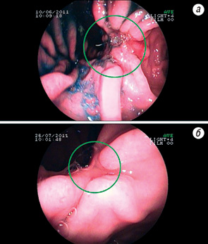 Рис. 2. Ендоскопічна картина клінічного випадку хворого М., 57 років. До проведення НПХТ було зареєстровано виразково-інфільтративну форму росту пухлини, що локалізувалася в нижній третині шлунка по малій кривизні. а — РШ, виразково-інфільтративна форма росту . б — РШ через 21 добу після проведення двох курсів НПХТ; зареєстровано відсутність інфільтрації слизової шлунка, зменшення розмірів виразки