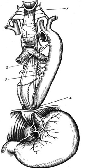 Рис. 1. Кровоснабжение пищевода. 1 — нижние щитовидные артерии; 2 — бронхиальные артерии; 3 — собственно пищеводные артерии; 4 — нижняя пищеводная артерия
