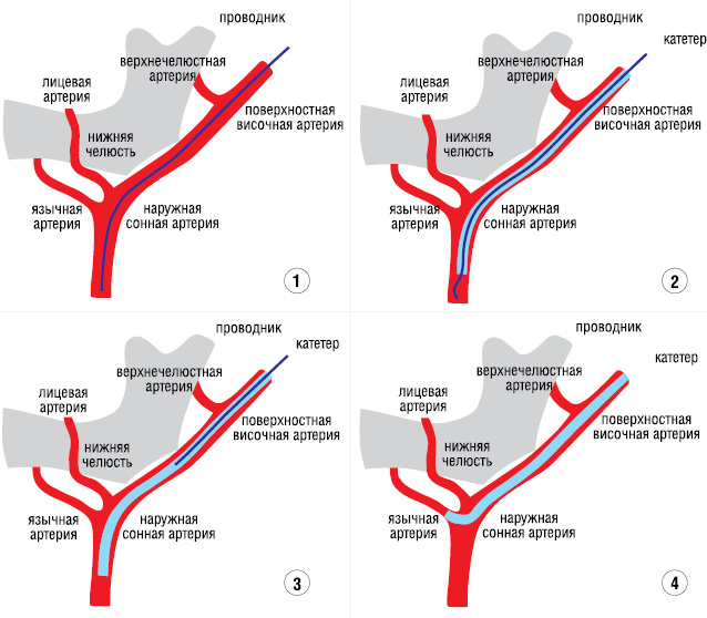 Рис. 1. Схема суперселективной катетеризации язычной артерии: 1 — через поверхностную височную артерию в наружную сонную артерию введен проводник; 2 — по проводнику в ствол наружной сонной артерии установлен катетер F5 «Cobra-3»; 3 — проводник частично извлечен, благодаря чему катетер принял вынужденную изогнутую форму; 4 — обратная тракция катетера сопровождается проникновением его концевого отдела в устье язычной артерии.