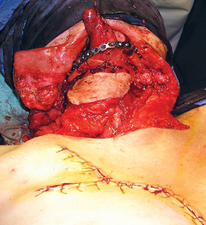 Рис. 4. Шкірно-м’язевий клапоть встановлено на місце дефекту дна порожнини рота. Рану на грудній стінці зашито