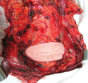 Рис. 2. Підгіоїдний шкірно-мязовий клапоть на етапі виділення. Сформована шкірна частина трансплантата