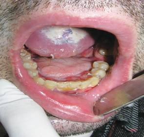 Рис. 4. Відновлення дна порожнини рота та слизової альвеолярного відростка нижньої щелепи