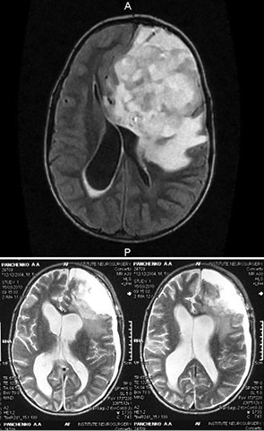 Рис. 2. МРТ ребенка П. до (а) и после (б) операции