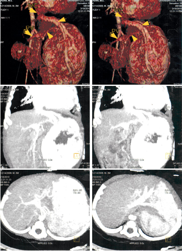 Рис. 3. Гемангиома левой доли печени с 3-D реконструкцией сердца (КТ-сканы)