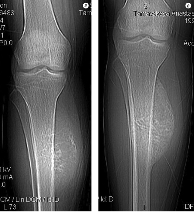 Рис. 1. Рентгенограма хворого на ОС до лікування (а) та після неоад’ювантної терапії (б)