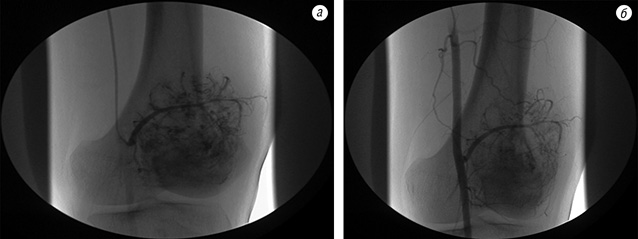 Рис. 5. Ангіограма хворої на ОС до лікування (а) та після неоад’ювантної терапії (б). Відсутність динаміки в неоваскуляризації