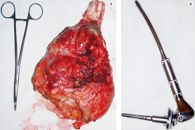 Рис. 6. а — видалений сегмент стегнової кістки. б — імплантат для реконструкції післяопераційного дефекту