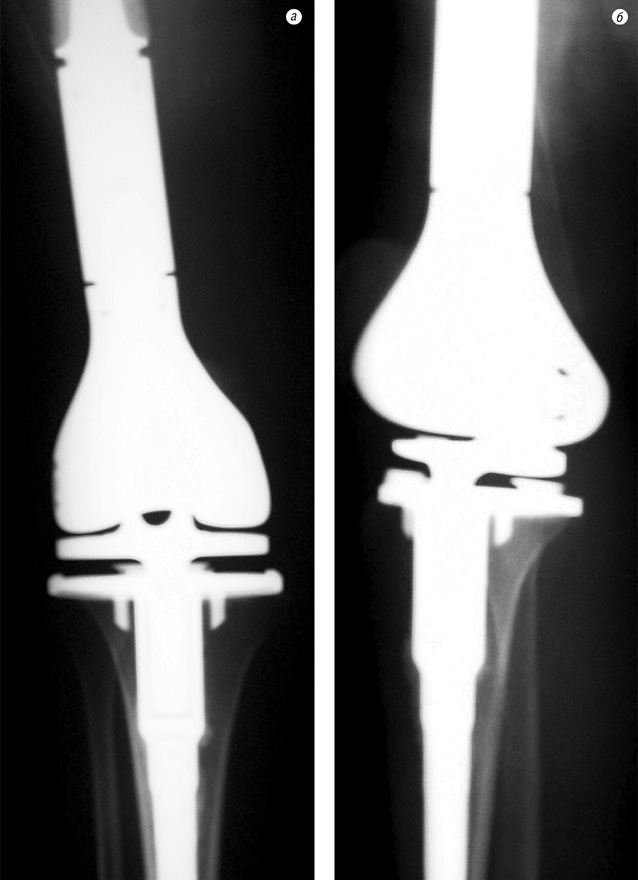Рис. 7. Рентгенограма колінного суглоба в прямій (а) та боковій (б) проекціях після хірургічного лікування