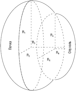 Рис. 1. Вычисление объема функцио­нирующей почки при экзофитной опухоли, где: R1 — радиус длины почки, R2 — радиус ширины почки, R3 — радиус толщины почки, R4 — радиус длины опухолевого поражения почки, R5 — радиус ширины опухолевого поражения почки, R6 — радиус толщины опухолевого поражения почки