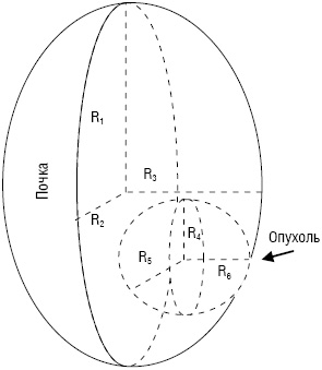 Рис. 2. Вычисление объема функционирующей почки при эндофитной опухоли, где: R1 — радиус длины почки, R2 — радиус ширины почки, R3 — радиус толщины почки, R4 — радиус длины опухолевого поражения почки, R5 — радиус ширины опухолевого поражения почки, R6 — радиус толщины опухолевого поражения почки