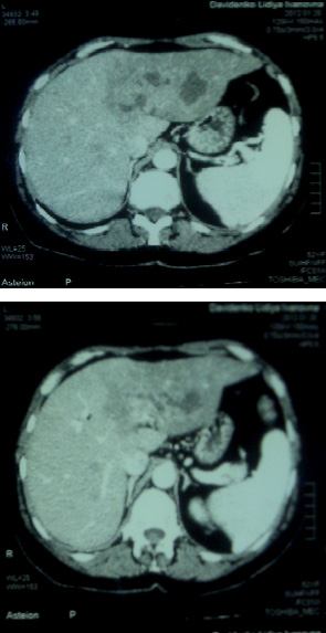 Рис. 1. Комп’ютерна томографія печінки хворої Д. до лікування