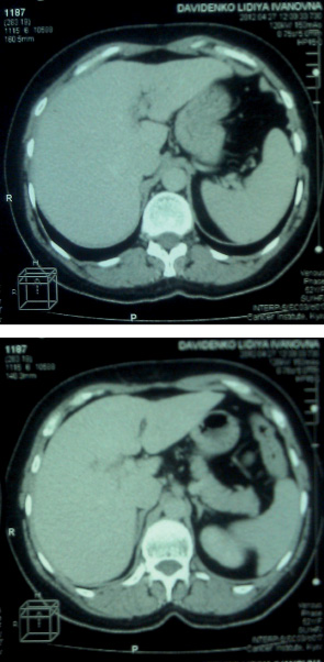 Рис. 2. Комп’ютерна томографія печінки хворої Д. після лікування