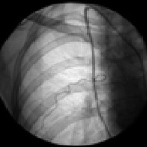 Рис. 2. Селективно катетеризирована правая внутренняя грудная артерия. Таргетная артерия начинается в типичном месте и участвует в кровоснабжении опухоли правой грудной железы
