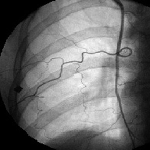 Рис. 5. МР РГЖ. Катетеризирована правая внутренняя грудная артерия. Прободающая артерия гипертрофирована, удлинена, огибает опухоль по окружности