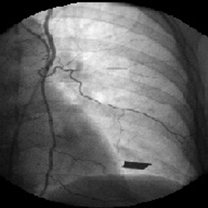 Рис. 7. МР РГЖ. Катетеризирована левая внутренняя грудная артерия. Таргетные сосуды исходят из гипертрофированной прободающей артерии (широкая стрелка)