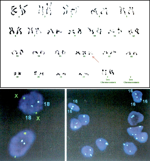 Рис. 3. Кариотип: mos47, XXX, +16[80] /46, XX[20]