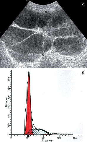Рис. 5. Полный ПЗ. Больная Д., 18 лет. а — лютеиновые кисты яичников, сонограмма; б — ДНК-гисто­грамма полного ПЗ
