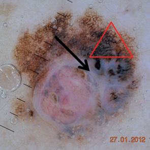 Рис. 2. Дерматоскопическое изображение меланомы кожи. Классическая триада признаков: асимметрия, атипичная сеть,бело-голубые структуры
