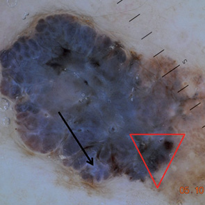Рис. 4. Дерматоскопическое изображение меланомы. Классическая триада признаков: асимметрия, атипичная сеть, бело-голубые структуры