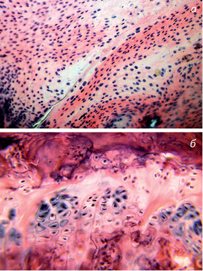 Рис. 5. Щури контрольної групи (резекція частини епіметафіза великогомілкової кістки). Гематоксилін-еозин: а) хрящова тканина без позиційної специфічності, яка заповнює суглобову щілину між стегновою та великогомілковою кісткою. Зб. 200; б) ділянка наросткового хряща великогомілкової кістки з порушеною структурою колонок, дистрофічними змінами в хондроцитах. Території без клітин у зонах збереженого хряща та проліферації. Зб. 400