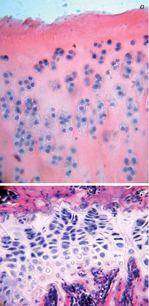 Рис. 6. Щури контрольної групи (резекція частини епіметафіза великогомілкової кістки). Ділянки хряща стегнової кістки. Гематоксилін-еозин. Зб. 400: а) суглобовий хрящ у ділянці збереженої суглобової щілини з вираженими деструктивними змінами в поверхневій зоні; б) ділянка збереженого наросткового хряща з колонками хондроцитів. Незначне порушення щільності хондроцитів у колонках. Кровоносні судини в зоні гіпертрофованих клітин