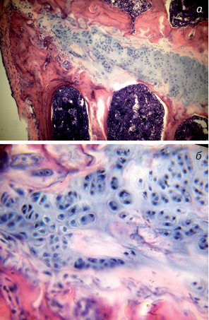 Рис. 7. Дослідні щури (ендопротезування проксимального епіметафіза великогомілкової кістки). Ділянка наросткового хряща великогомілкової кістки щура. Гематоксилін-еозин: а) порушення структури колонок хондроцитів. Зб. 80; б) виражені дистрофічні і деструктивні зміни хондроцитів у колонках. Зб. 400