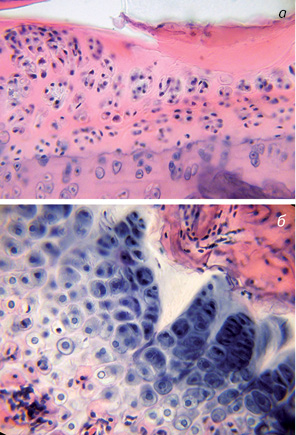 Рис. 8. Дослідні щури (ендопротезування проксимального епіметафіза великогомілкової кістки). Ділянки хряща стегнової кістки. Гематоксилін-еозин: а) суглобовий хрящ стегнової кістки з деструкцією поверхневої зони та порушеною цитоархітектонікою. Зб. 200; б) наростковий хрящ із чіткою структурою колонок хондроцитів та характерним взаємовідношенням клітин у зонах. Зб. 400
