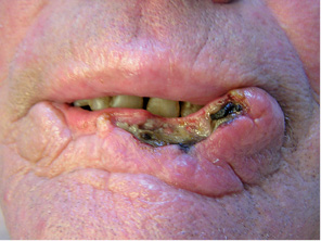 Рис. 1. Хворий Б. Рак нижньої губи. Тотальне ураження