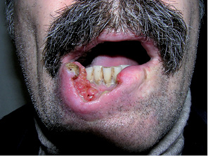 Рис. 4. Хворий Н. Рак нижньої губи. Тотальне ураження