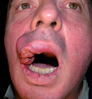 Рис. 9. Хворий І. Рак верхньої губи 
