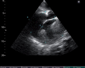 Рис. 6. Эхограмма сердца. Апикальная 4-камерная позиция, В-режим. Дилатация полостей правого, левого предсердий (обозначено дистанцией) с пристеночными гиперэхогенными структурами (тромботические массы)