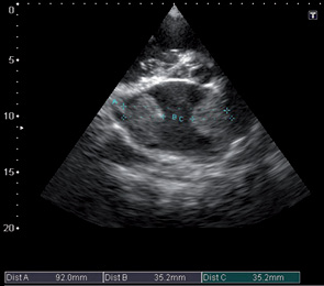 Рис. 7. Эхограмма сердца. Короткая ось на основании аорты. В-режим. Расширенное ЛП с пристеночно расположенными гиперэхогенными структурами неправильной округлой формы (тромботические массы)
