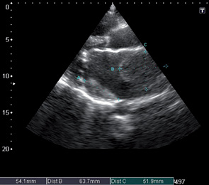 Рис. 8. Эхограмма сердца (позиция по длинной оси ЛЖ). В-режим. Увеличенное левое предсердие с наличием пристеночно расположенных изо-, гиперэхогенных структур (тромботических масс). Обозначены дистанцией 