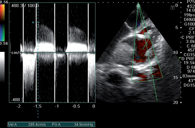 Рис. 3. Эхограмма сердца. Апикальная 4-камерная позиция. В-, Д-режимы. Допплерографические параметры комбинированного митрального порока