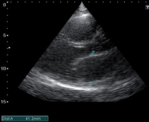 Рис. 9. Эхограмма сердца. Продольная ось на основании ЛЖ, В-режим. Расширение полости ЛП (обозначено дистанцией)