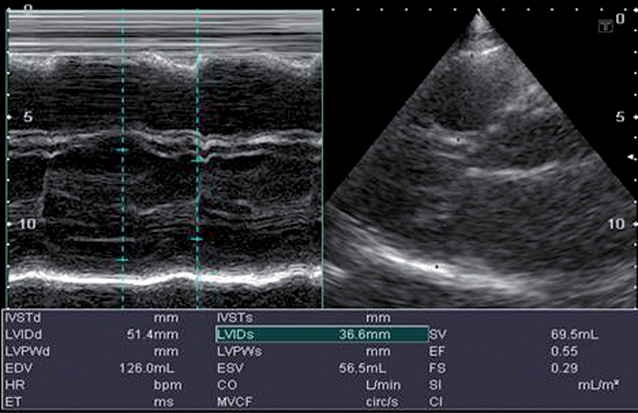 Рис. 12. Эхограмма сердца. В -, М-режимы. Сократительная способность миокарда ЛЖ — 55%
